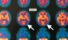 HBOT näyttää parantuneen Alzheimerin tautit